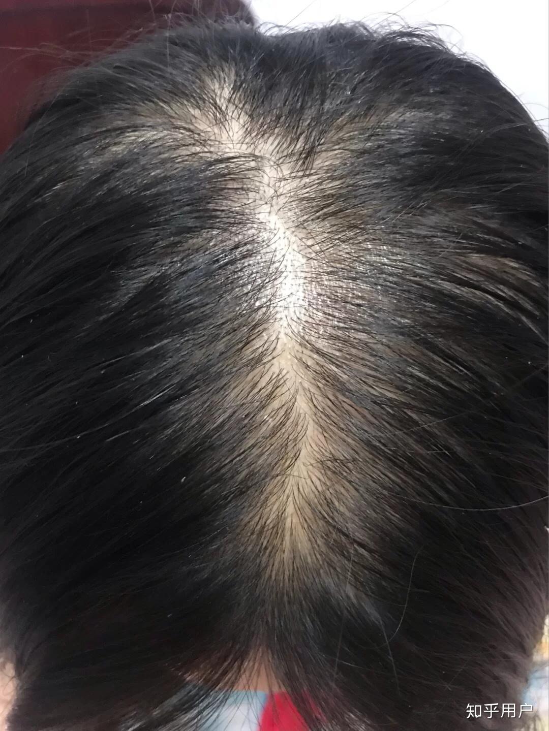 女生怎么样不掉头发 v2-6a269e8d0d6669080788127b14f42a42_r.jpg