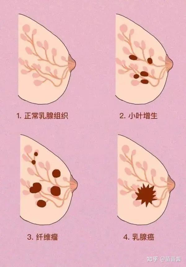 乳腺癌已成为全球最常见的癌症关于如何预防你知道多少