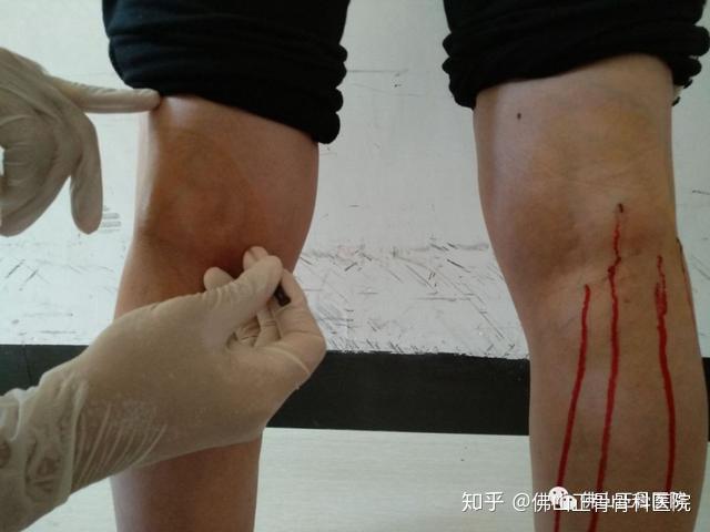 膝盖放血的位置图片图片