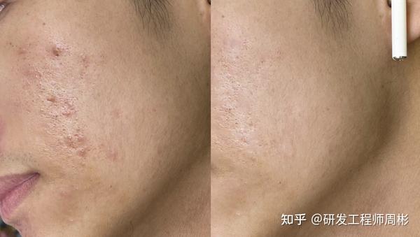 男生皮肤油腻,粗糙,暗黄,快黑成碳了根本不知道怎么办?
