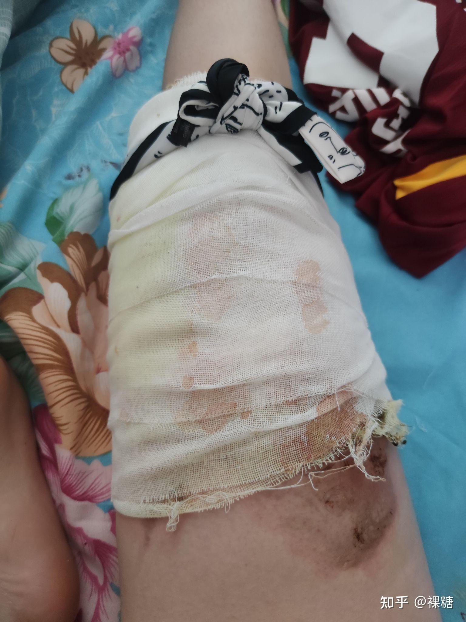 烫伤恢复记录 - 知乎