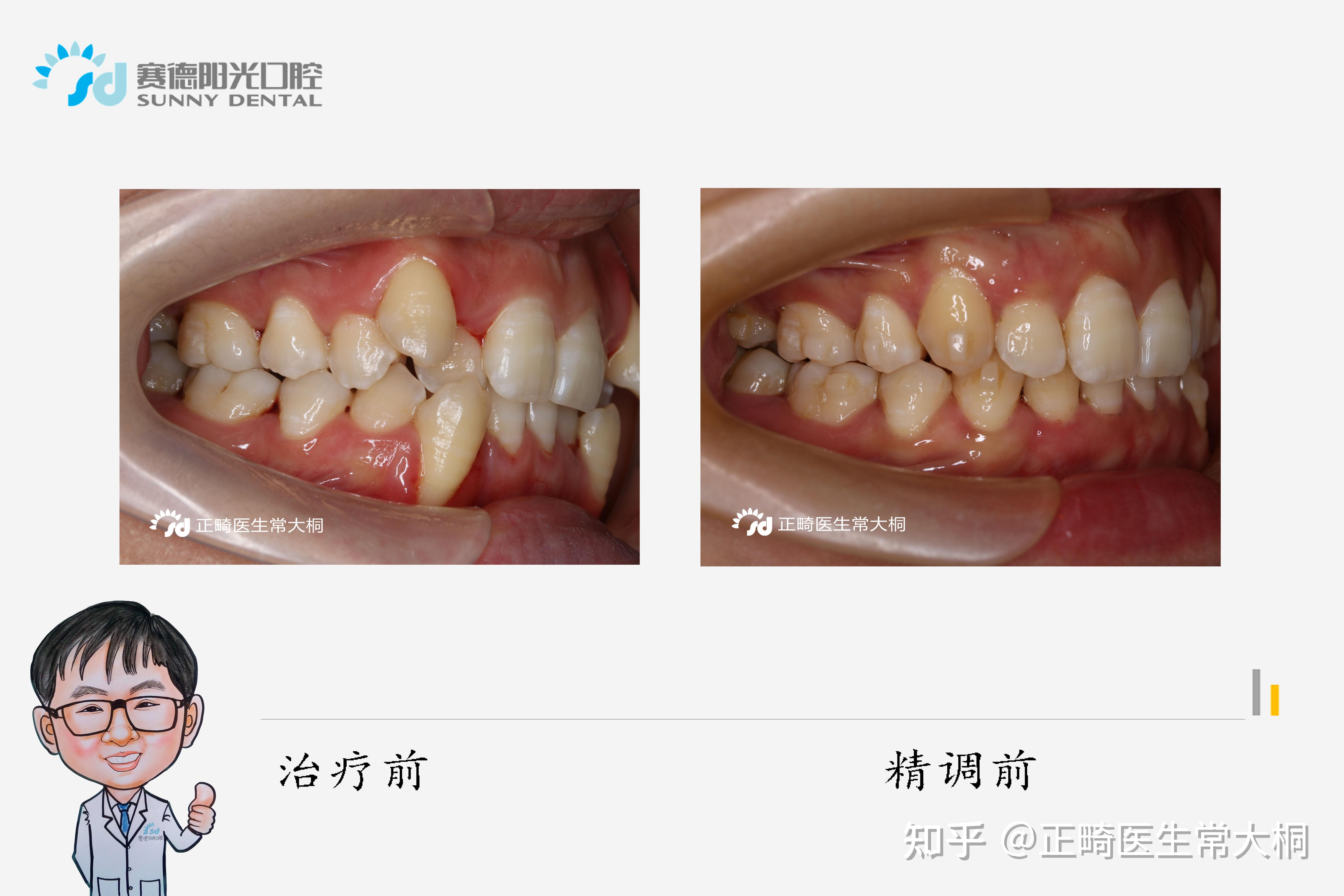 每周案例隐适美矫治器拔牙矫治重度牙列拥挤牙不齐