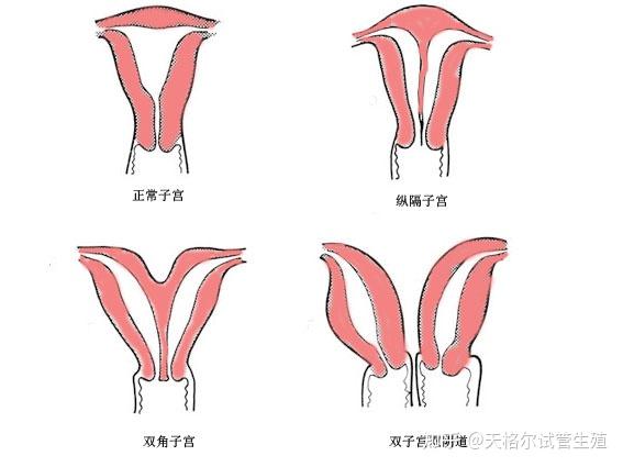 羊角子宫可以怀孕么? - 知乎