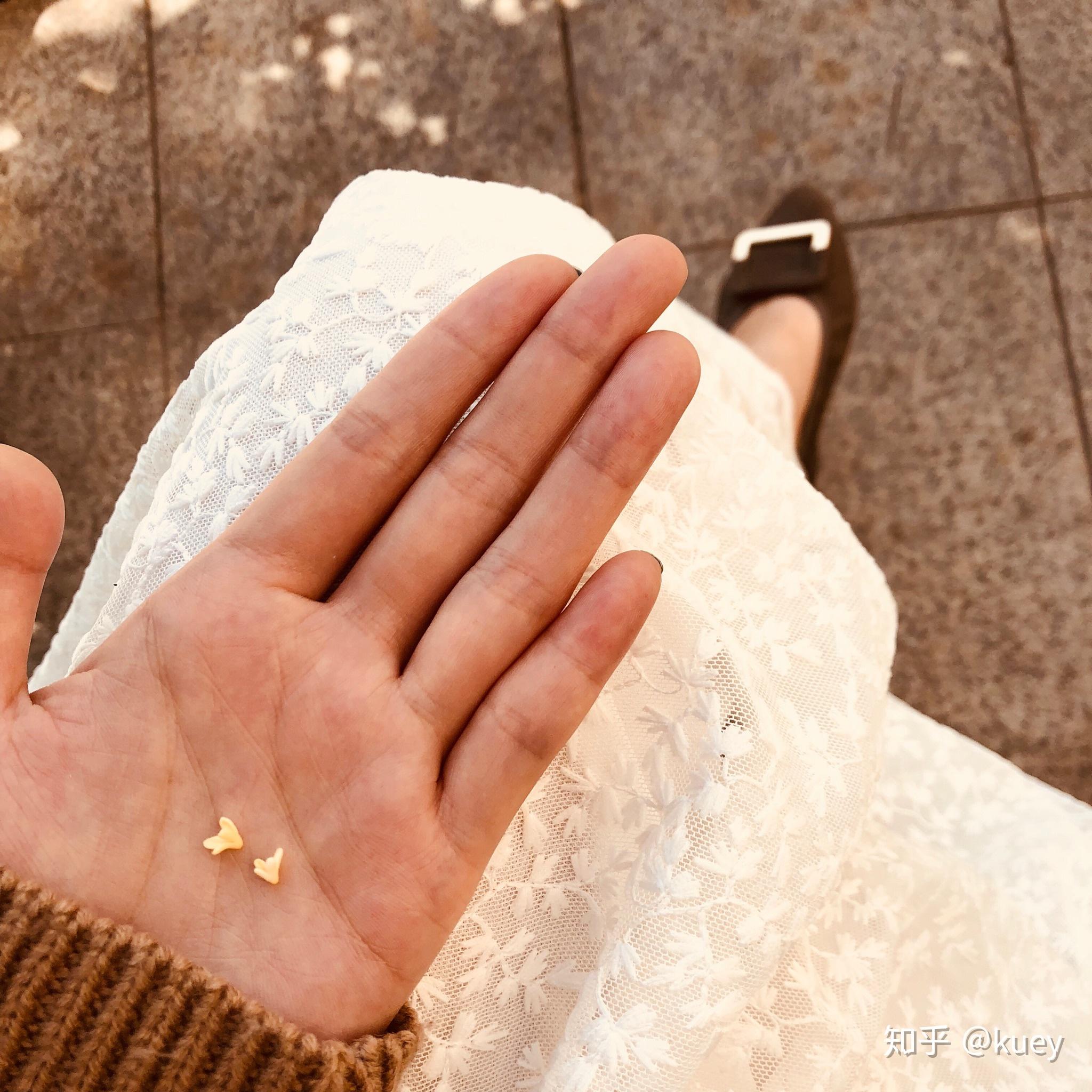 为什么我的大拇指又宽又短?