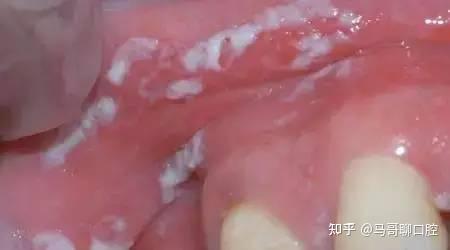 口腔常见十大疾病，有一个你都得上心了 - 知乎