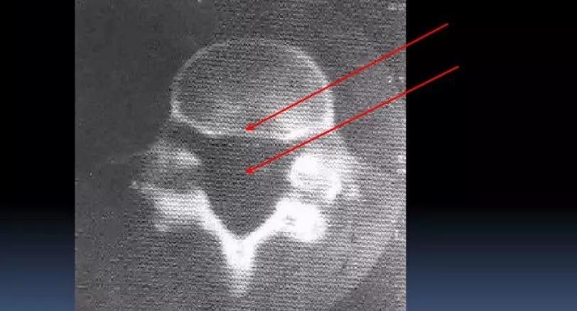 椎管前后径延长"双管征"滑脱椎体"双边征"(三)腰椎mri片椎弓峡部层