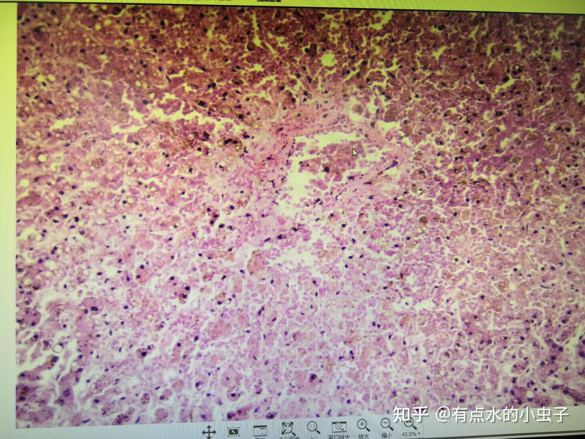 子宮頸原位癌鱗狀上皮化生肝細胞水腫(急性肝炎)先整理這些有空再來