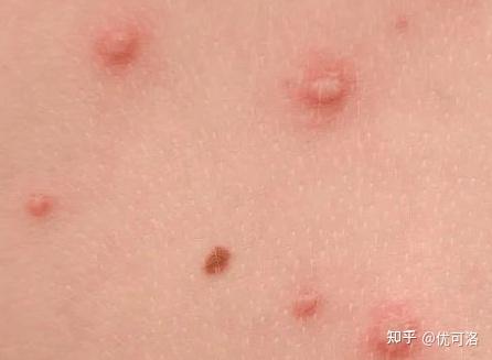症状:1,外阴疣体要是持续性的感染上了hpv病毒低危型,在早期女性的