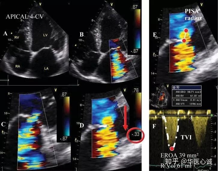 超声心动图十大基本功82：二尖瓣关闭不全的超声评估 知乎 7204
