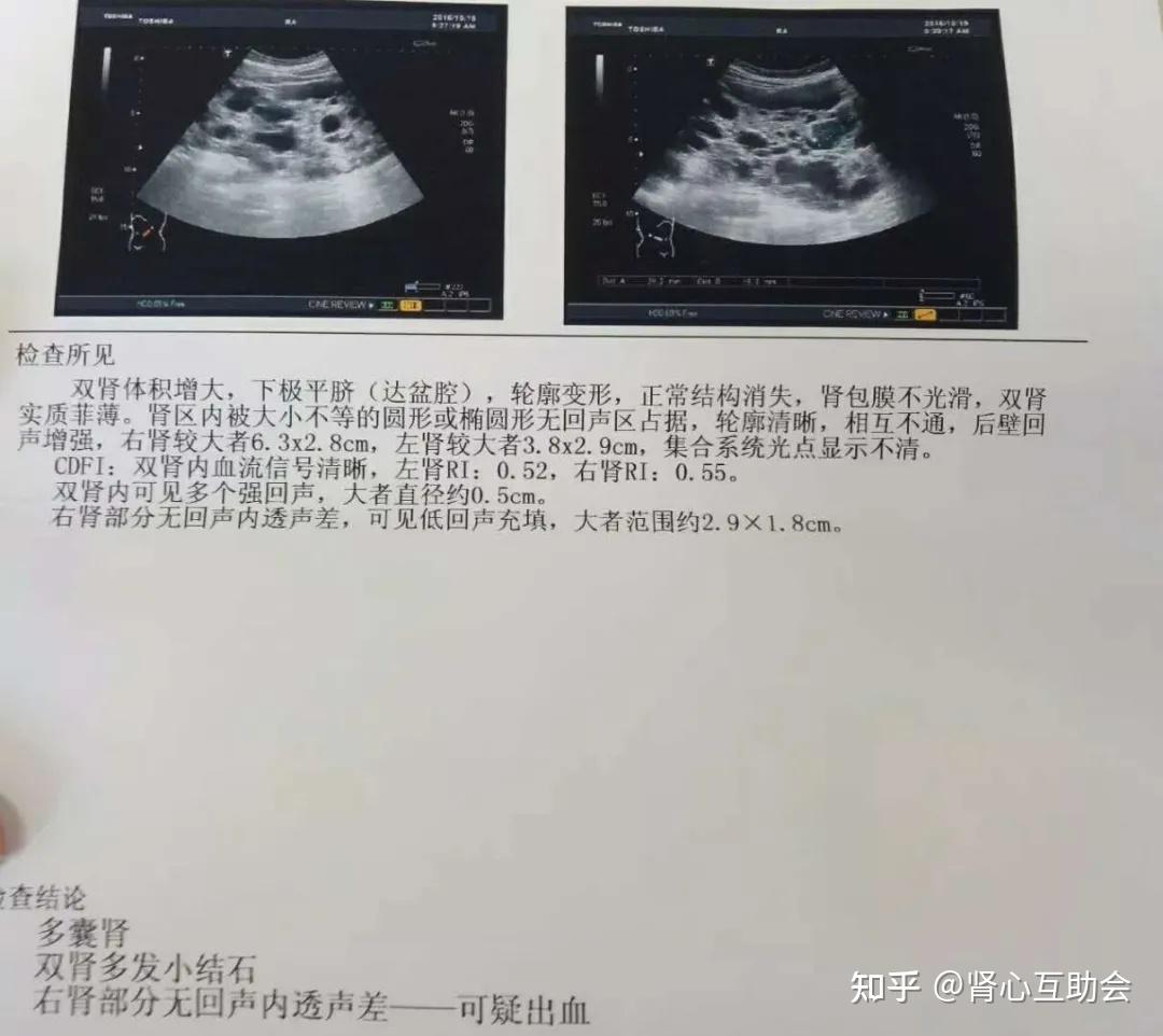 带您了解遗传性肾病多囊肾