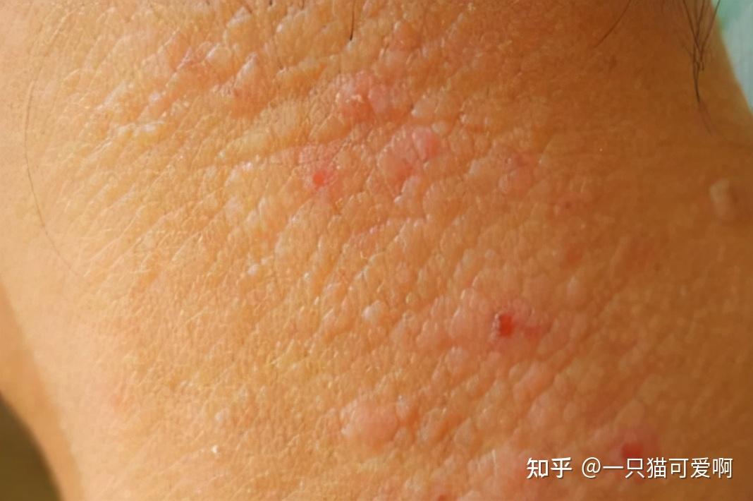 患者自述:皮肤痒了二三年,以为是过敏,体检查出hpv16