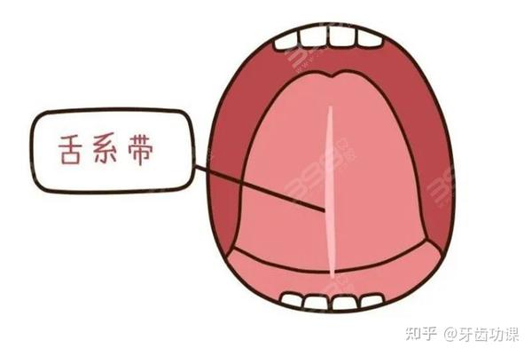 孩子舌筋短要不要剪？宝宝发音不清楚就剪舌系带，白挨了 - 知乎