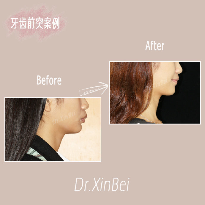 女孩主诉牙齿突,嘴唇形态不好看,通过好朋友介绍找我做矫正.