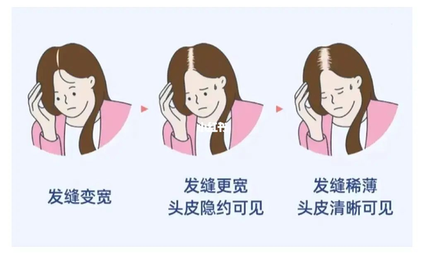 脱发8年,发缝越来越宽?这个方法是她重新长出茂密头发 - 知乎