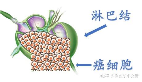 转移淋巴结的状态
