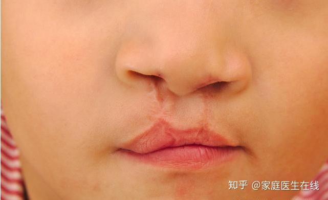 宝宝为什么会长兔唇?揪出来的4个“祸根”,后三个可避开! - 知乎