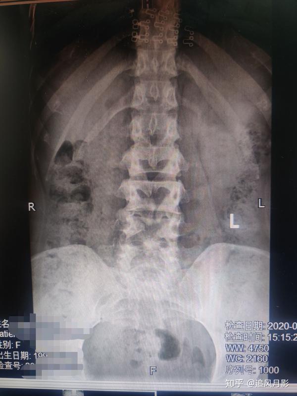 脊柱裂 显性图片