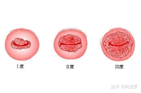 一种坑了无数女性得病,真的和性生活有关吗? - 知乎