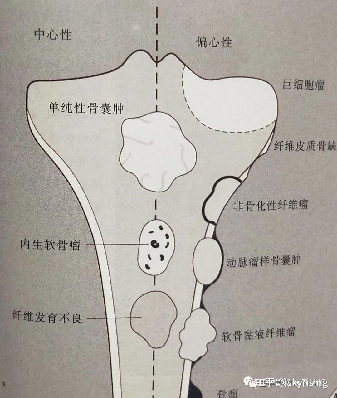 【影诊思维】058老年女性椎体附件区溶骨性破坏肿瘤,您的诊断?病理结果:脊索瘤 - 知乎
