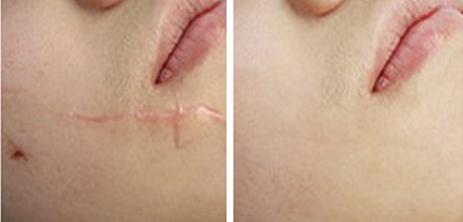 宁波整形常见的淡化疤痕的方法有哪些为爱美的你增添美感
