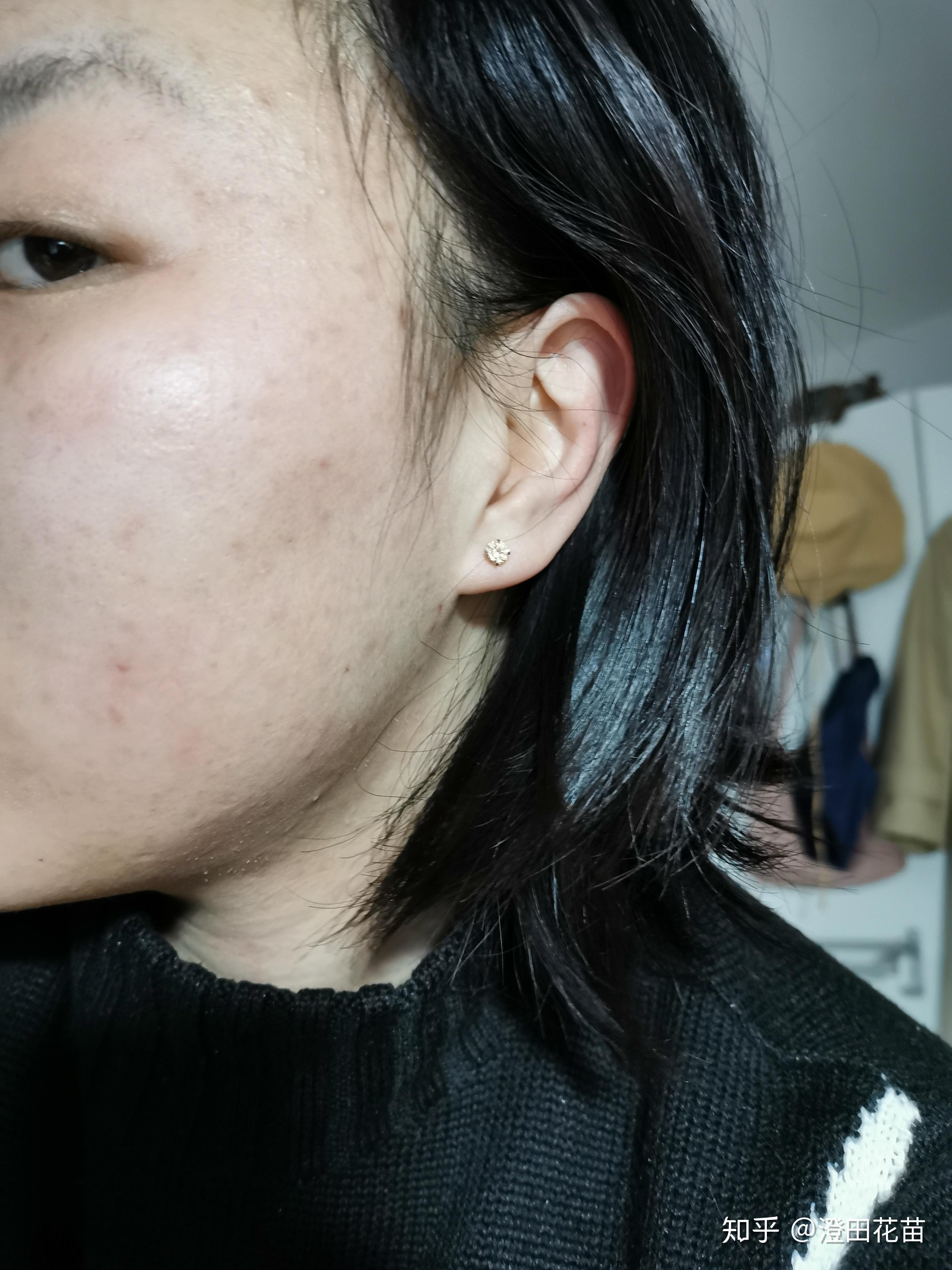 阿达帕林和什么治鸡皮肤(鸡皮肤涂阿达帕林多长时间才能消除)
