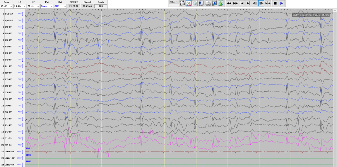 脑电图报告里的各种波形都是什么意思? - 知乎