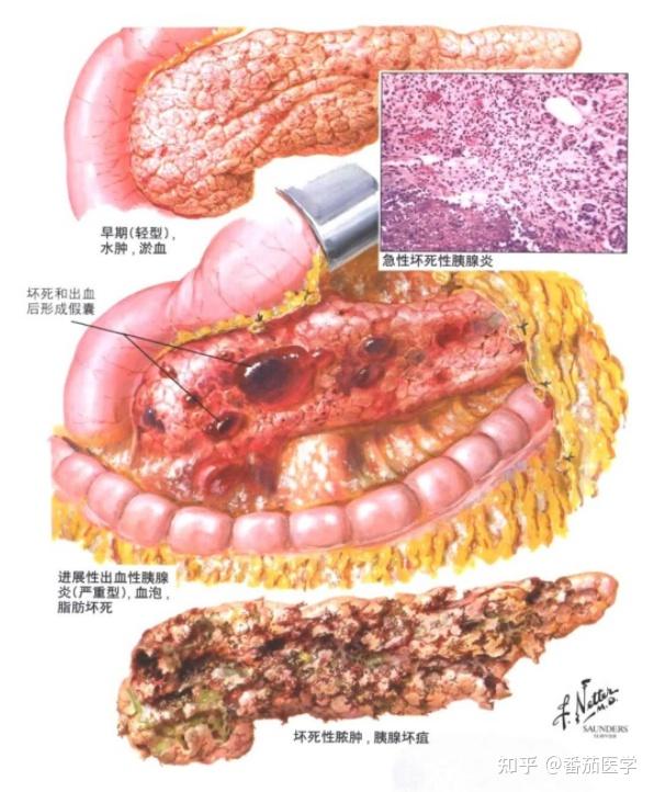 急性出血性胰腺炎图片