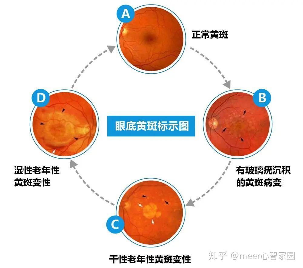 右眼视力突降竟源于家庭消费观的冲突情志疗法案例转系心智家园教育