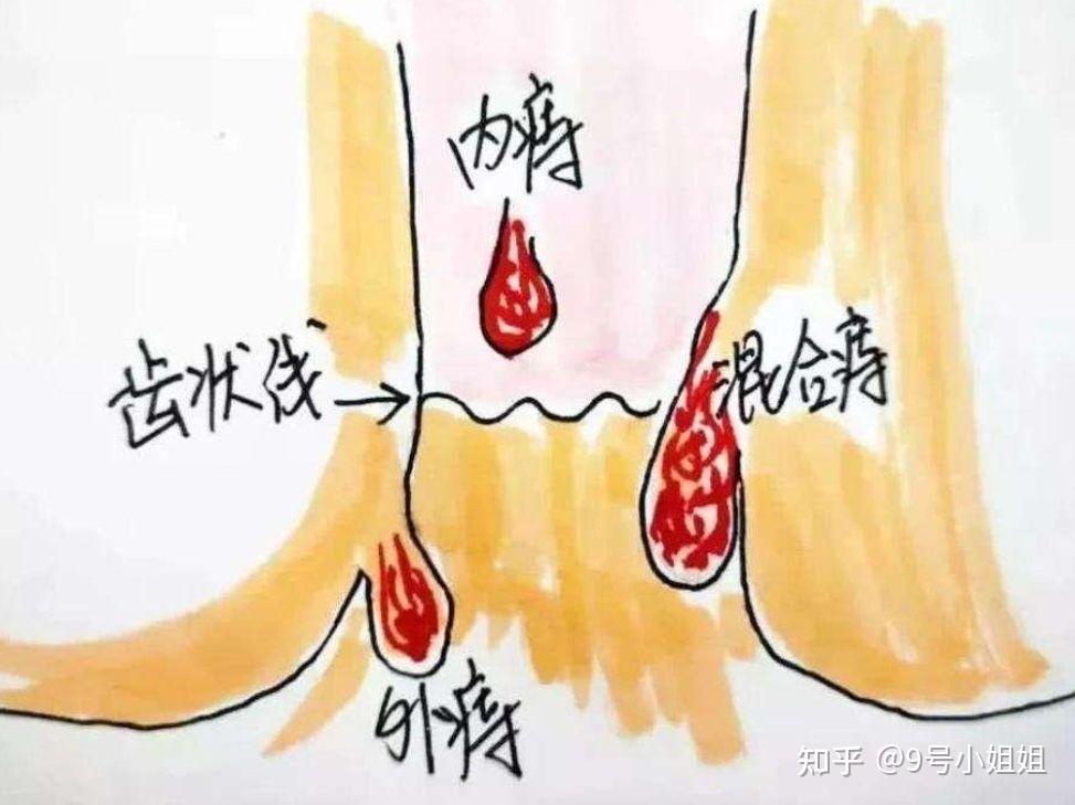 如何辨别是否患有痔疮? - 知乎
