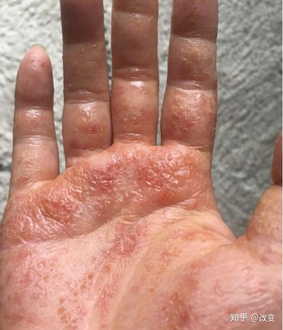 我当初得湿疹可能就是年龄增大了,免疫力下降,又突遭毒虫咬引起,反正
