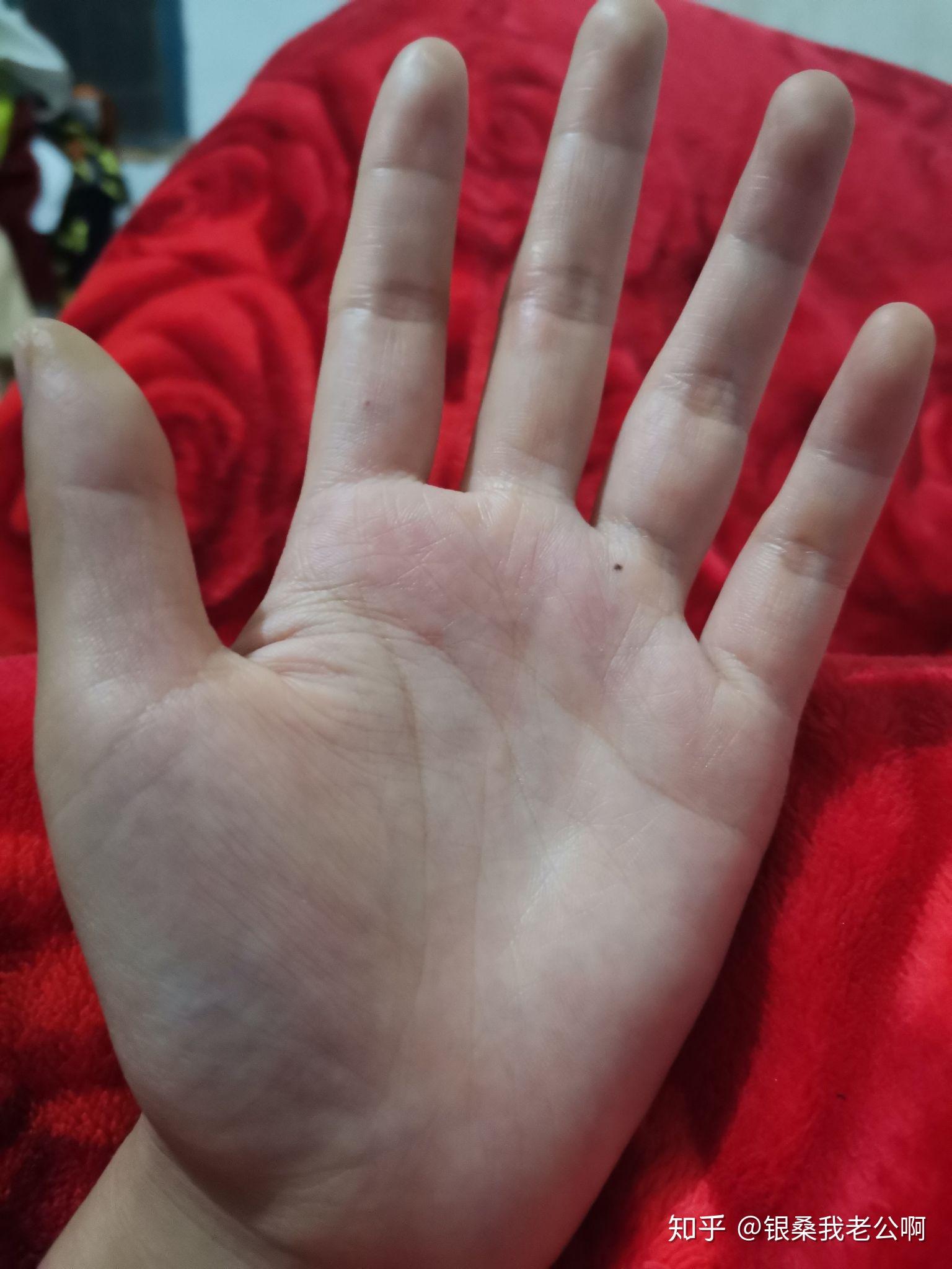 掌心有痣是什么体验