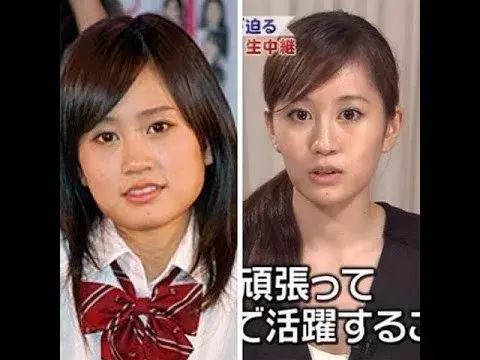 你所不知道的日本整容手术隆鼻篇