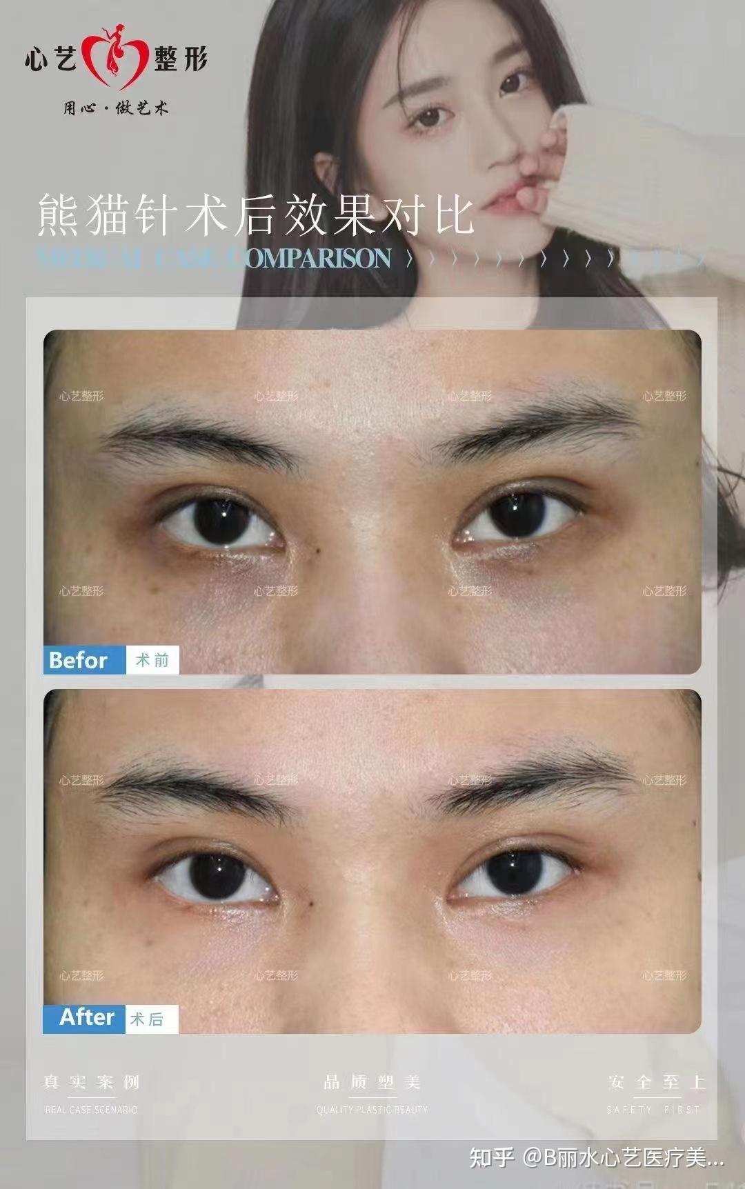 熊猫针效果对比