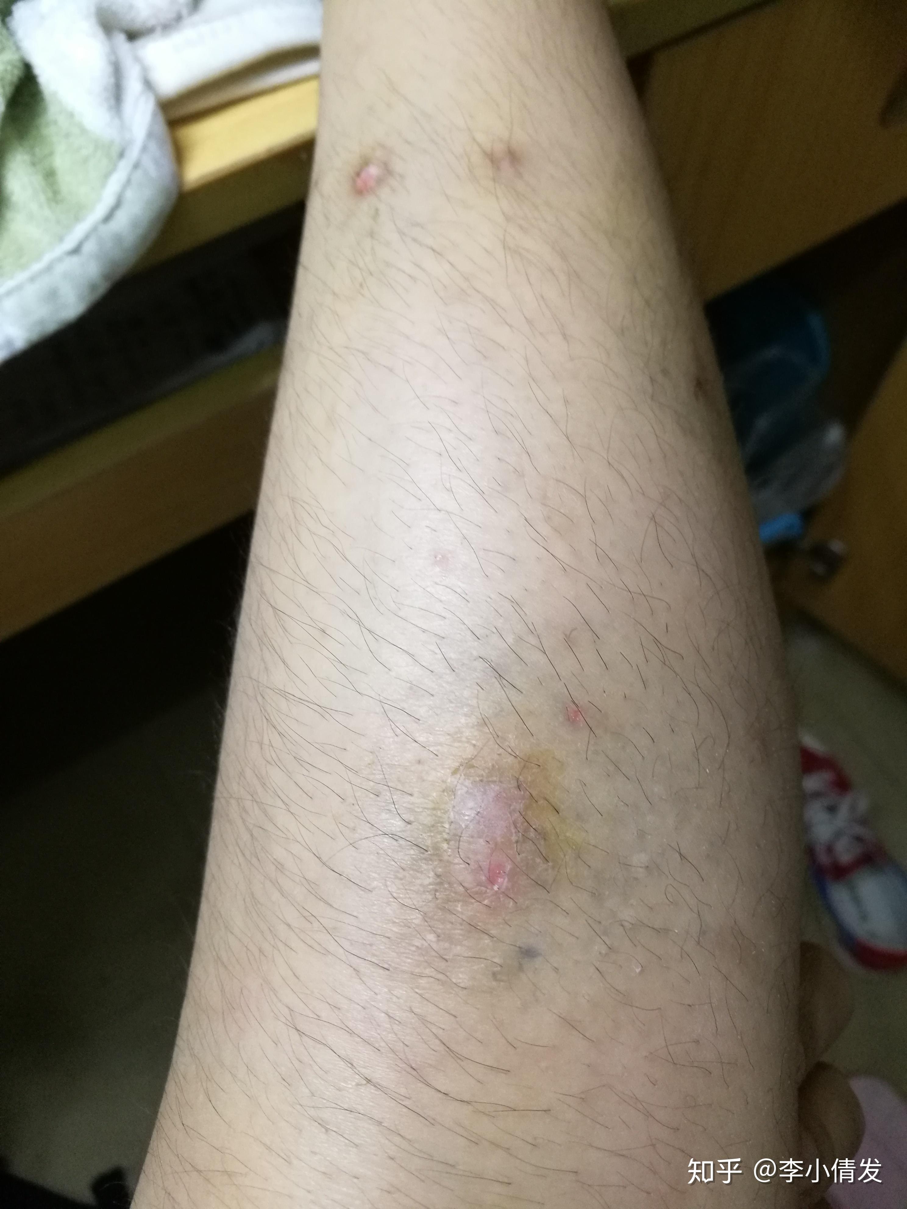 成人湿疹 - 知乎