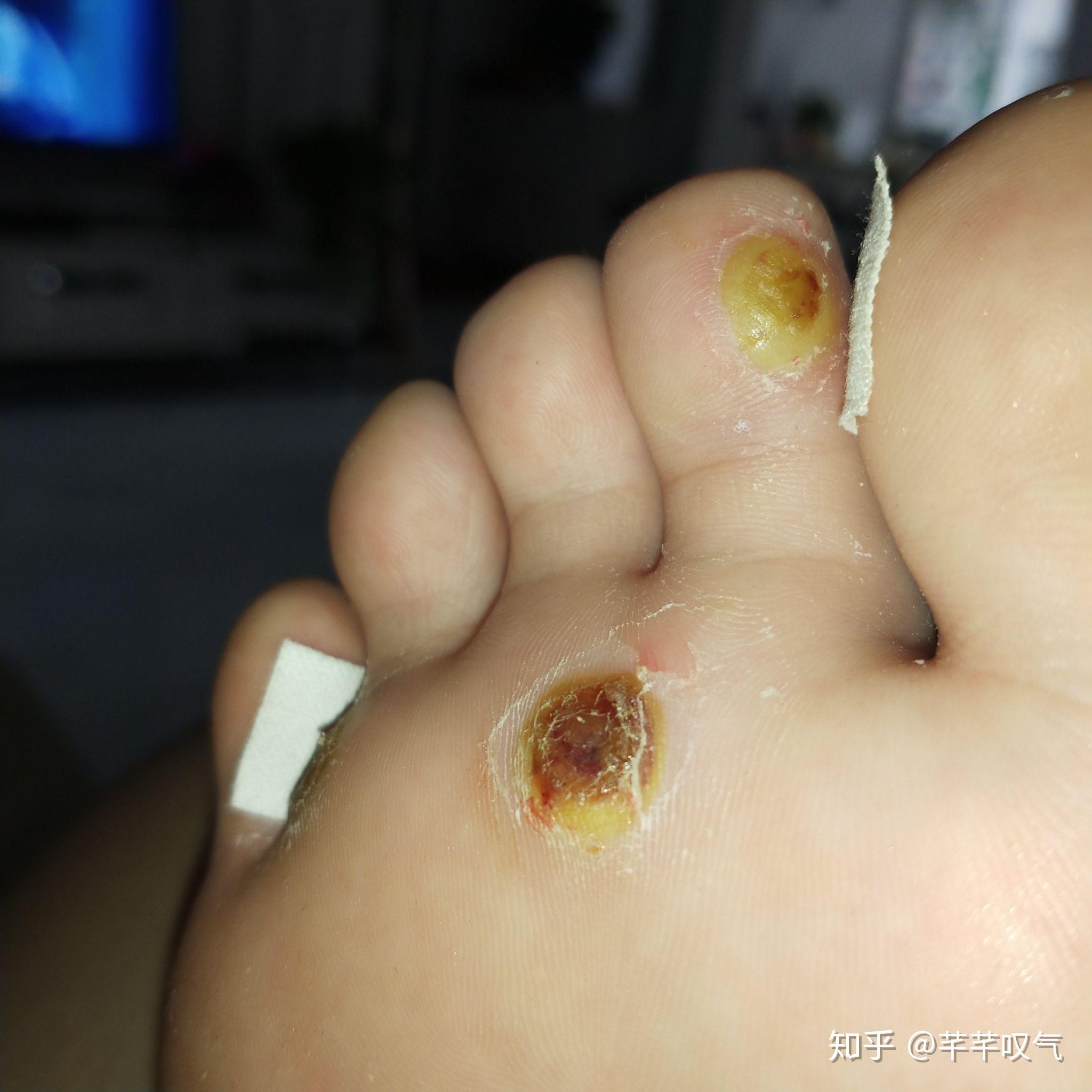 鸦胆子治疣的方法 zhuanlan.zhihu.com