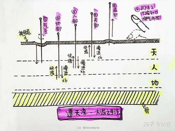 人纪针灸笔记(19)针刺法 - 知乎
