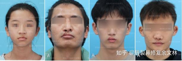 兔唇能修复得看起来和正常人一样吗? - 知乎