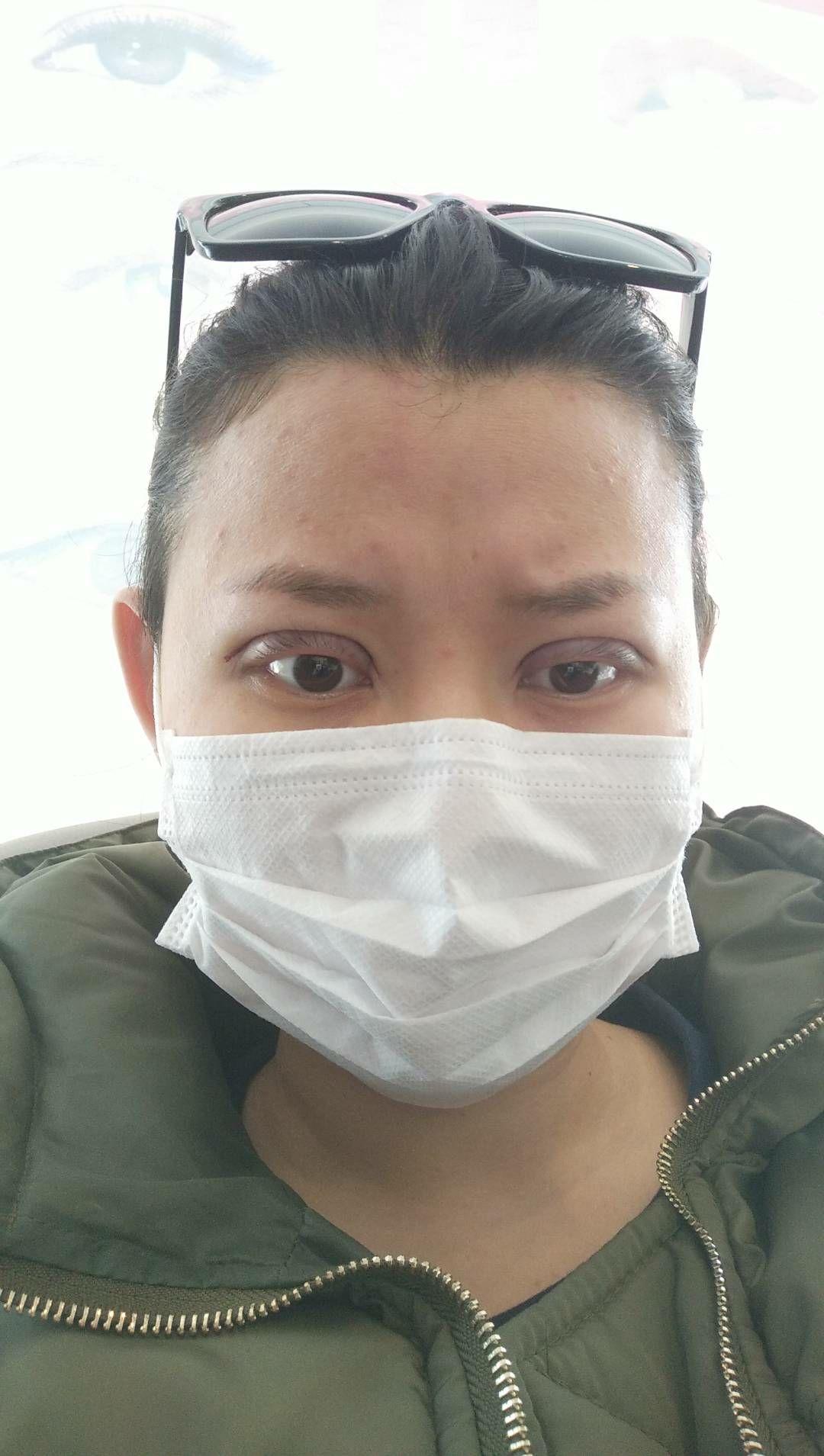 割眼皮 知乎
