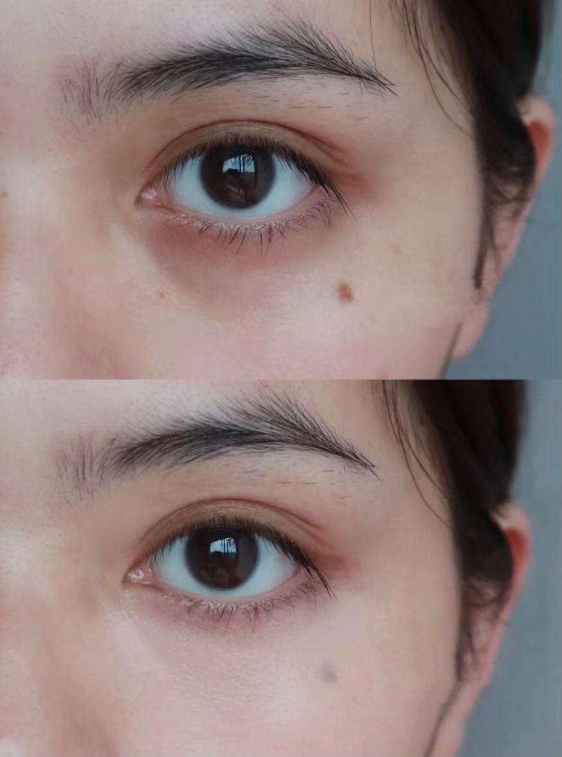 如何去除黑眼圈?