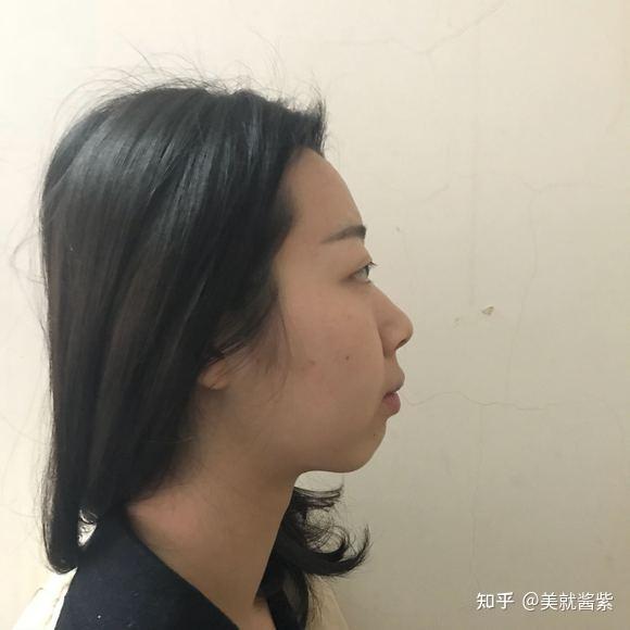 北京颏成型手术细节分享,没有对比就没有伤害!