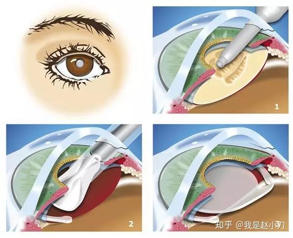 浅前房是怎么回事08的视力为什么医生却建议做白内障