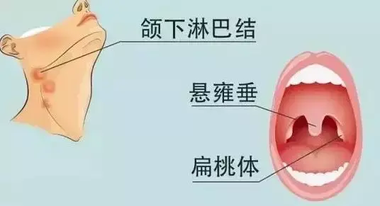 扁桃体位于口腔消化道和呼吸道的交会处的淋巴器官,含有大量淋巴组织