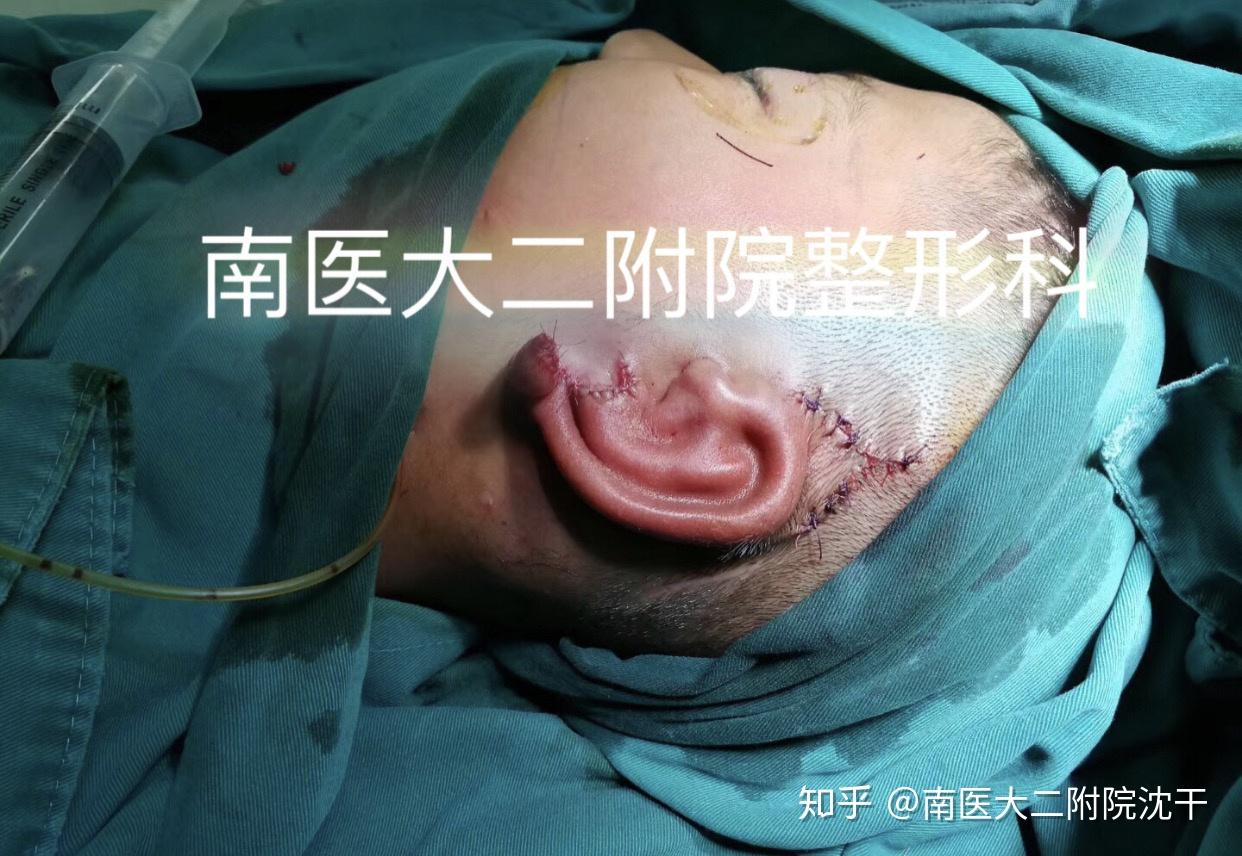 南医大二附院沈干#小耳畸形 dr·s 知乎