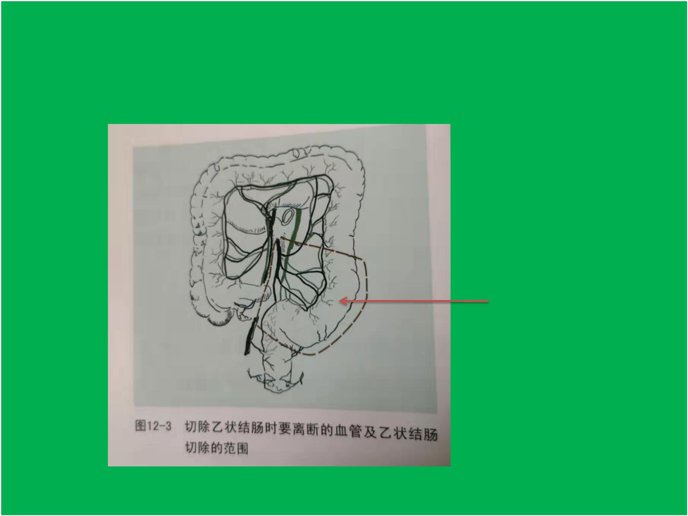 乙状结肠癌手术步骤图图片