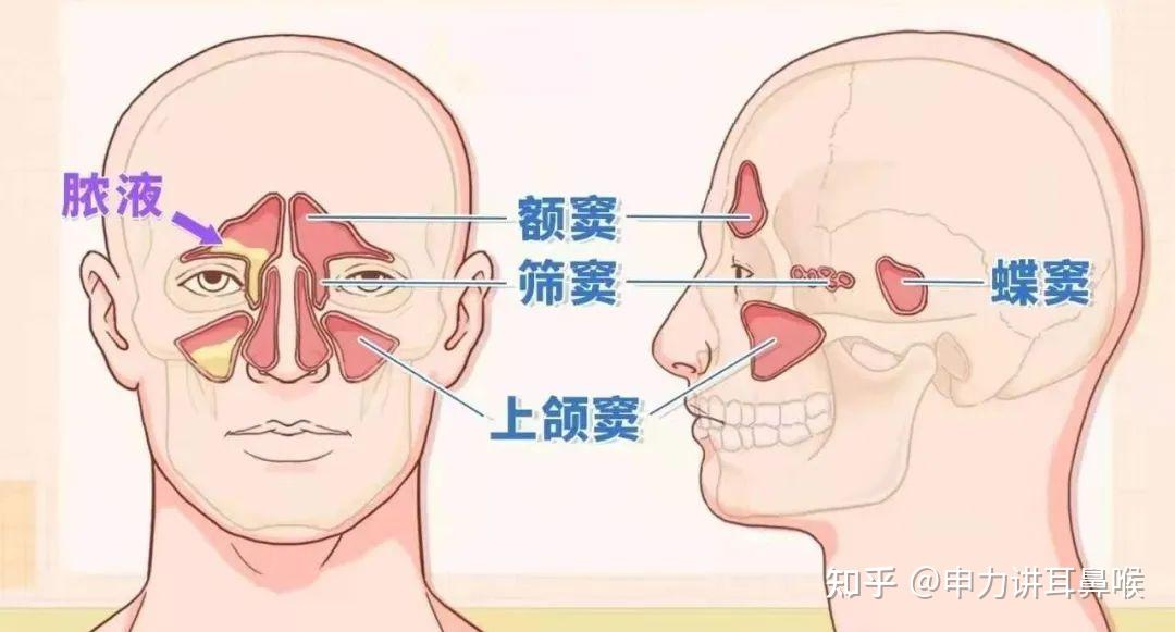 鼻窦炎头痛位置图解图片