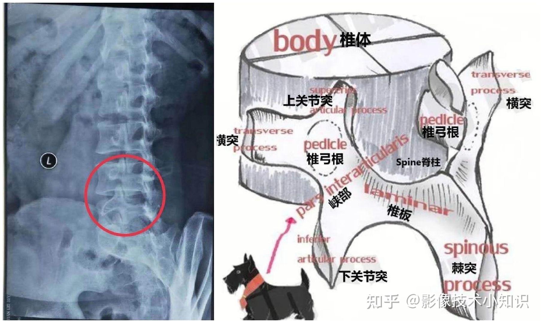 怎么看腰椎滑脱? - 知乎