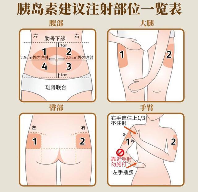 糖友看过来 胰岛素注射技术全攻略 拿走不谢 知乎