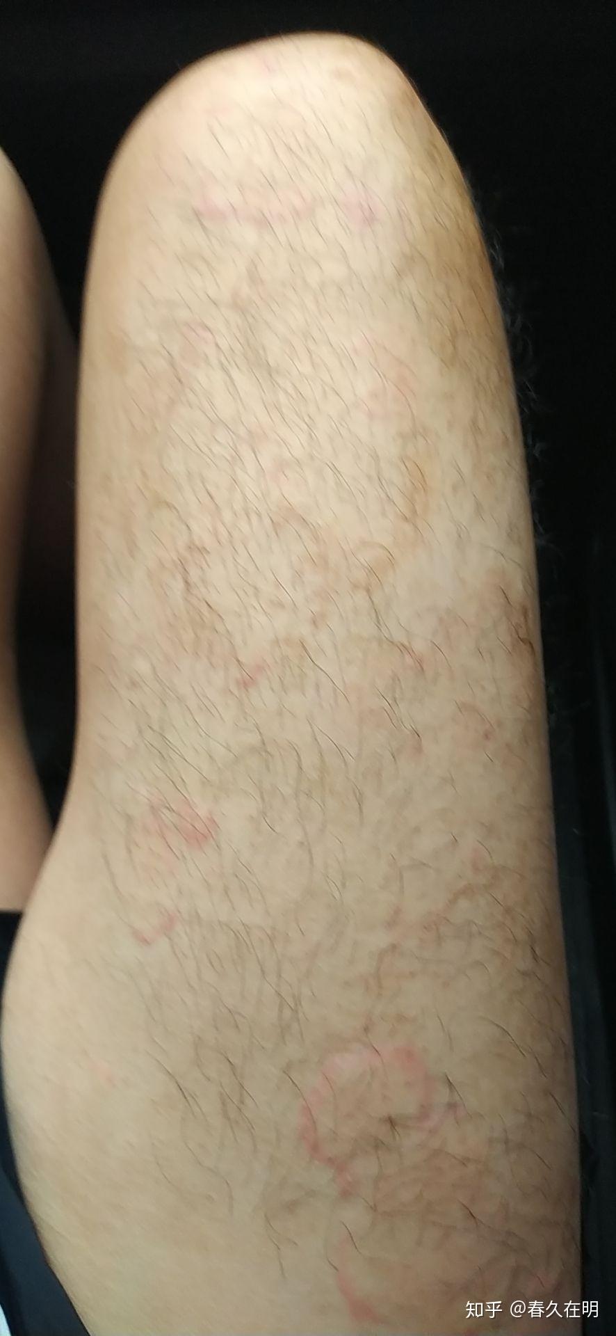 离心性环状红斑艰难求医过程治愈