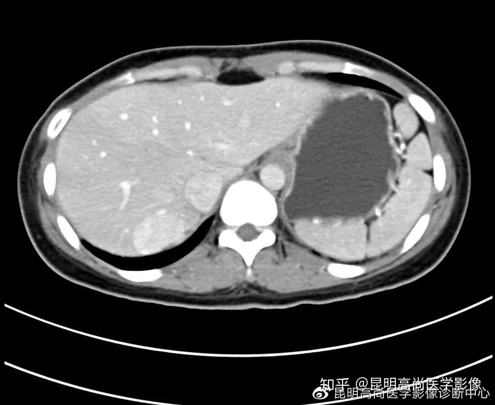 昆明高尚医学影像诊断中心【病例】上腹部ct肝脏局灶性结节增生!