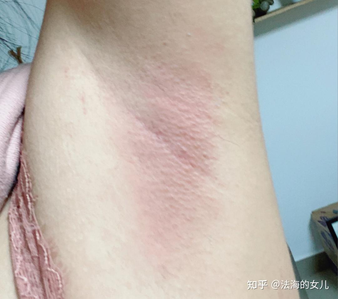 不狐闹 全网最全腋下管理!如何脱腋毛,腋下黑保证不狐臭的正确方式!!! - 知乎